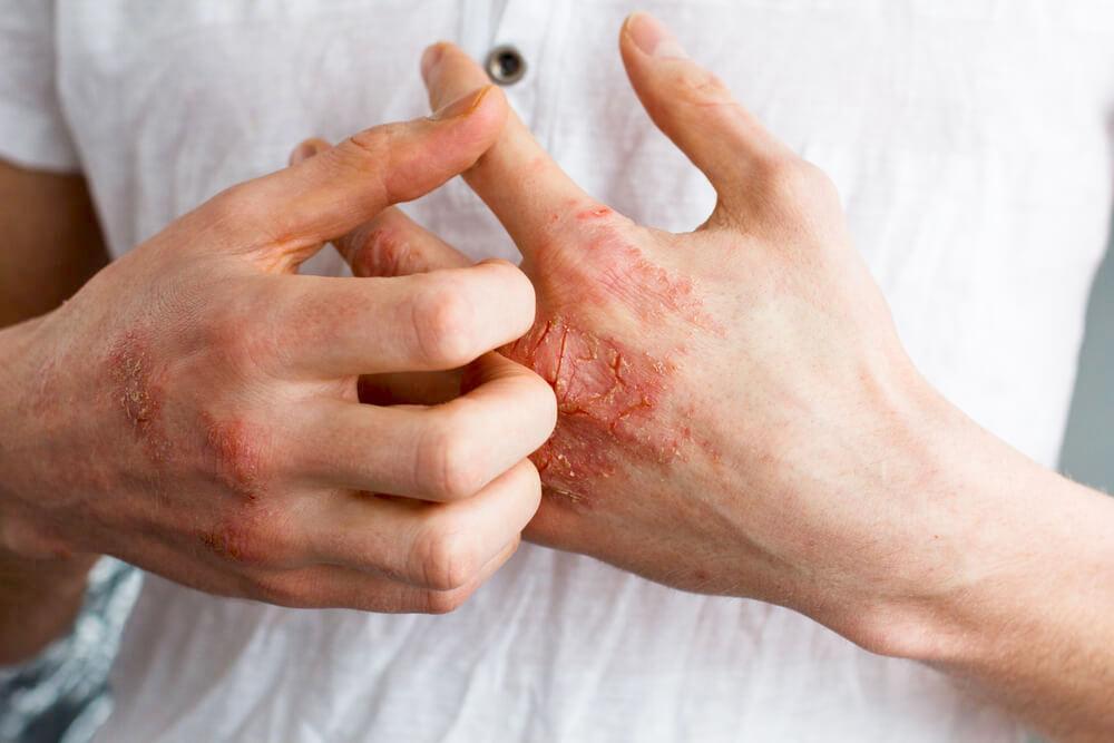 eczema on hands
