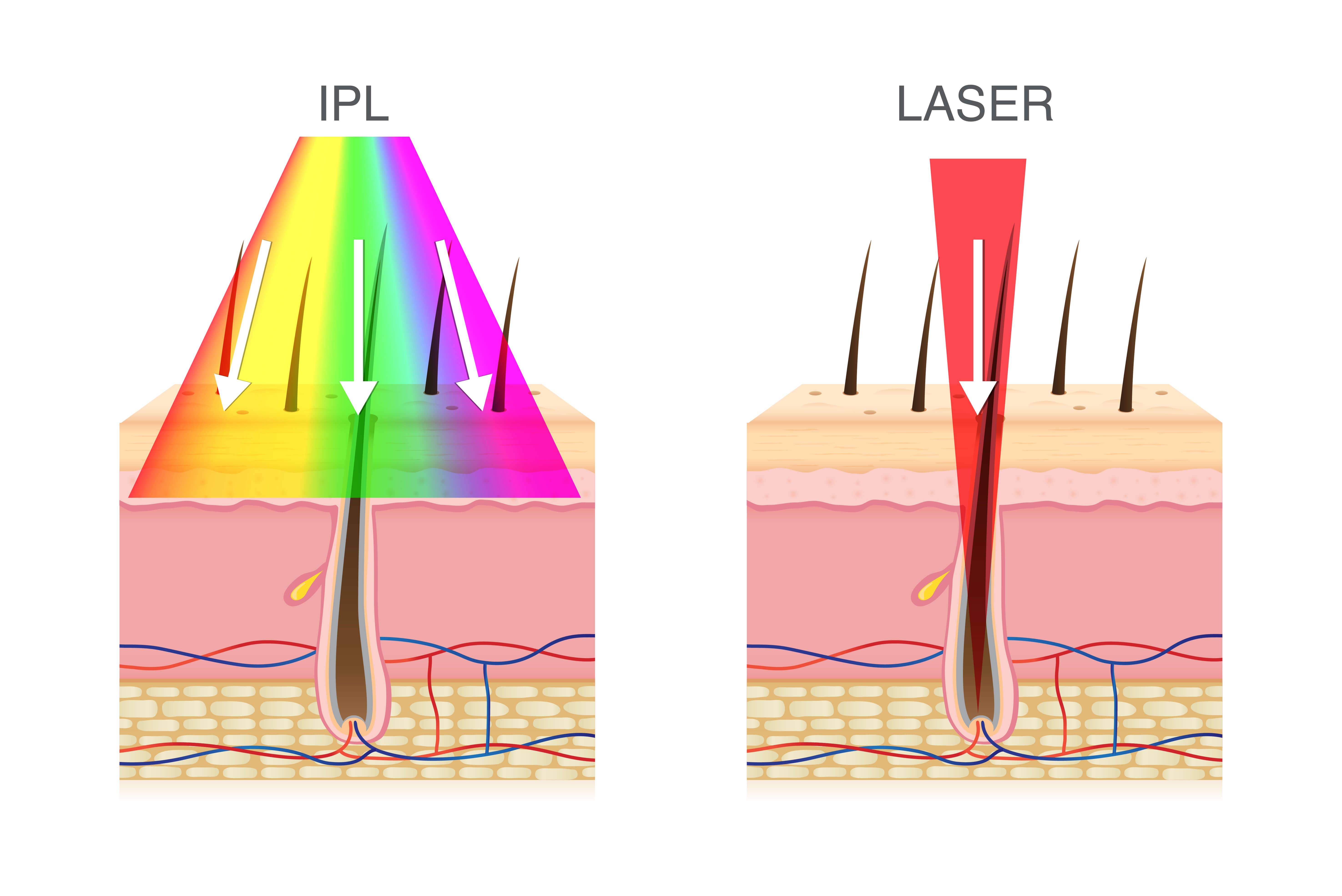 Чем отличается лазер. IPL И диодный лазер. Диодный лазер hair removal. Диодный vs александритовый лазер.