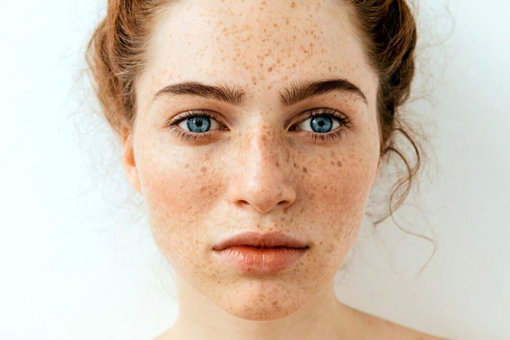 8-ways-to-fade-and-hide-dark-spots-on-the-face-amore-mi