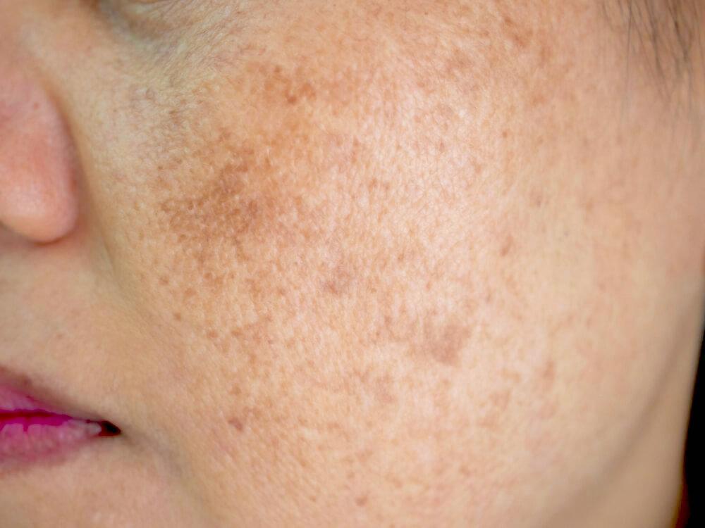 Close-up of woman's face with melasma