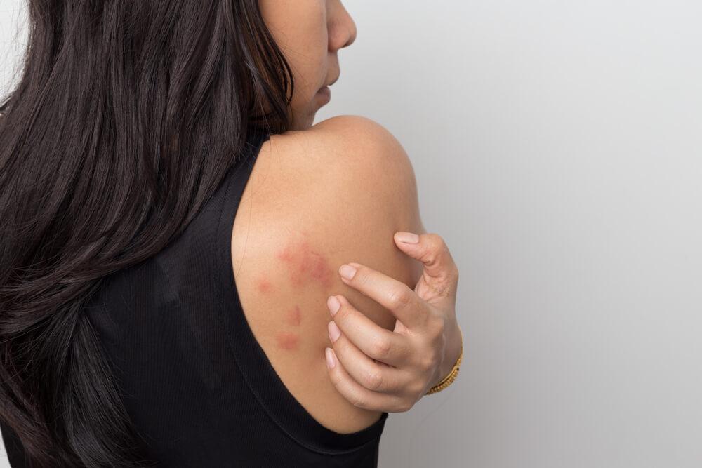 Woman with rash on back