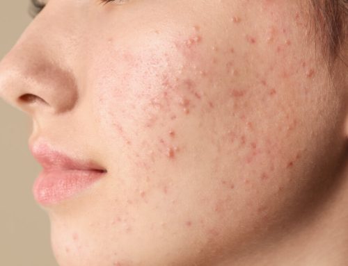 Acne Uncovered: Busting Myths About Clear Skin