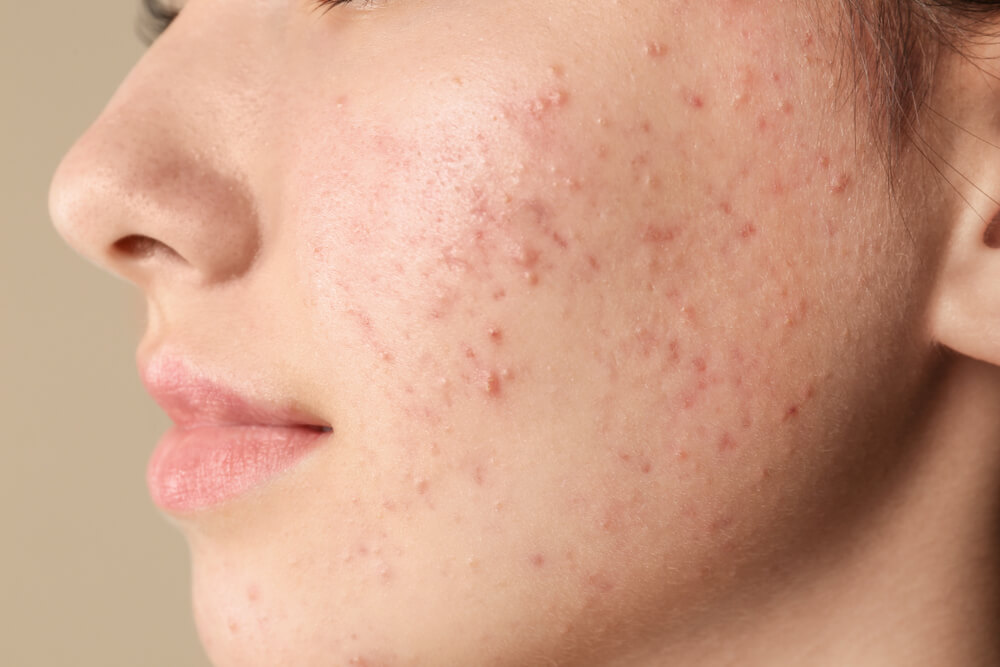 Acne Uncovered: Busting Myths About Clear Skin