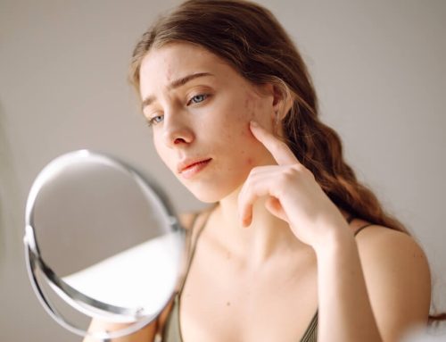 Battling Breakouts: Effective Solutions for Acne-Prone Skin