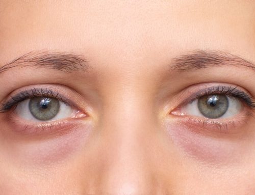 Dark Circles? Here’s How to Fix Them for Good